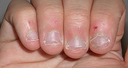 kako prestati sa grickanjem noktiju